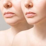 Group logo of Defining the Jawline and Correcting Loose Skin for a Refined Profile